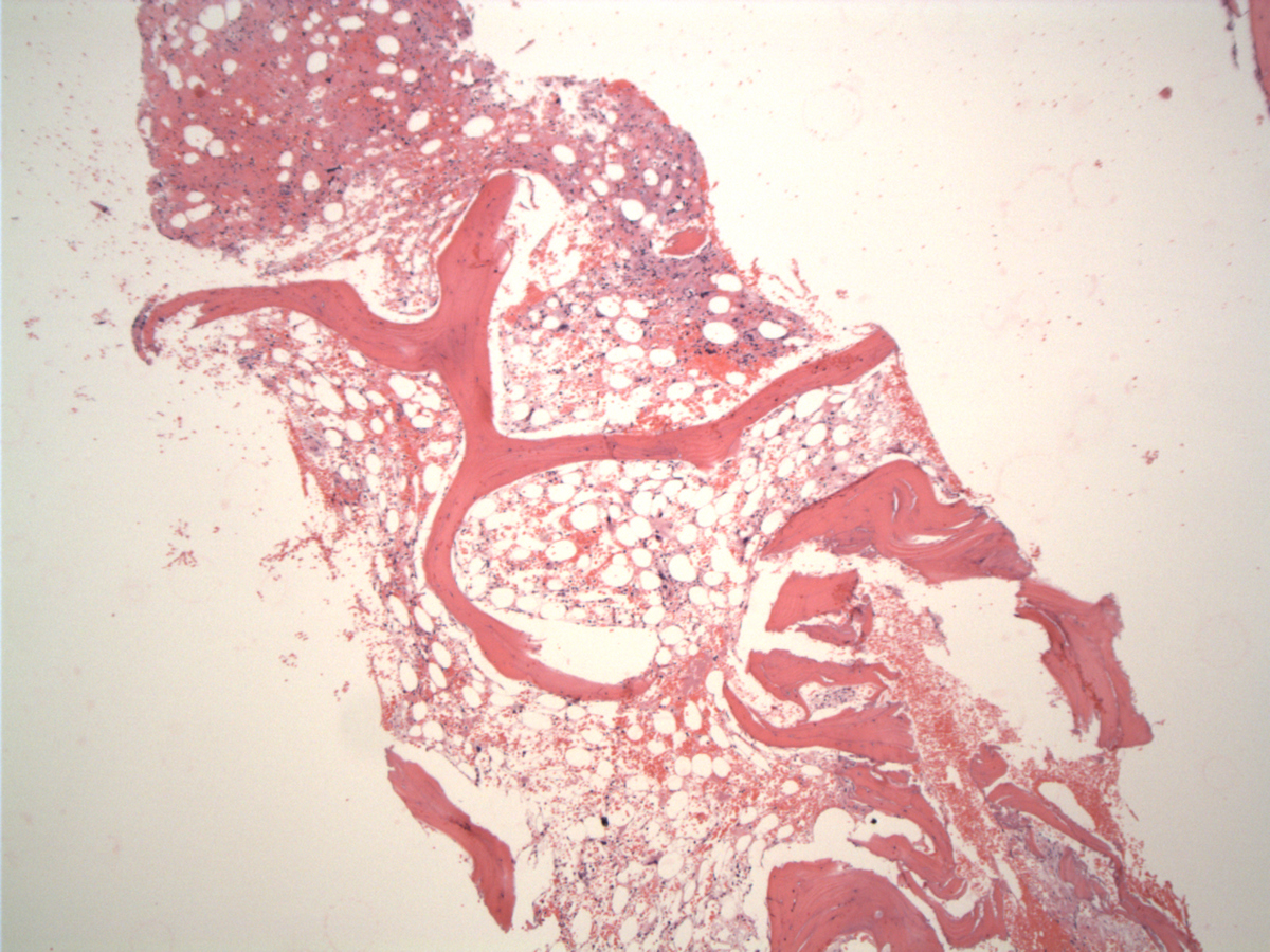 Hypocellular marrow space with stromal injury